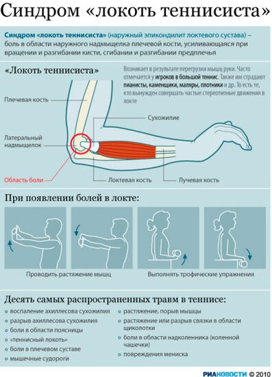 Синдром "локоть теннисиста"