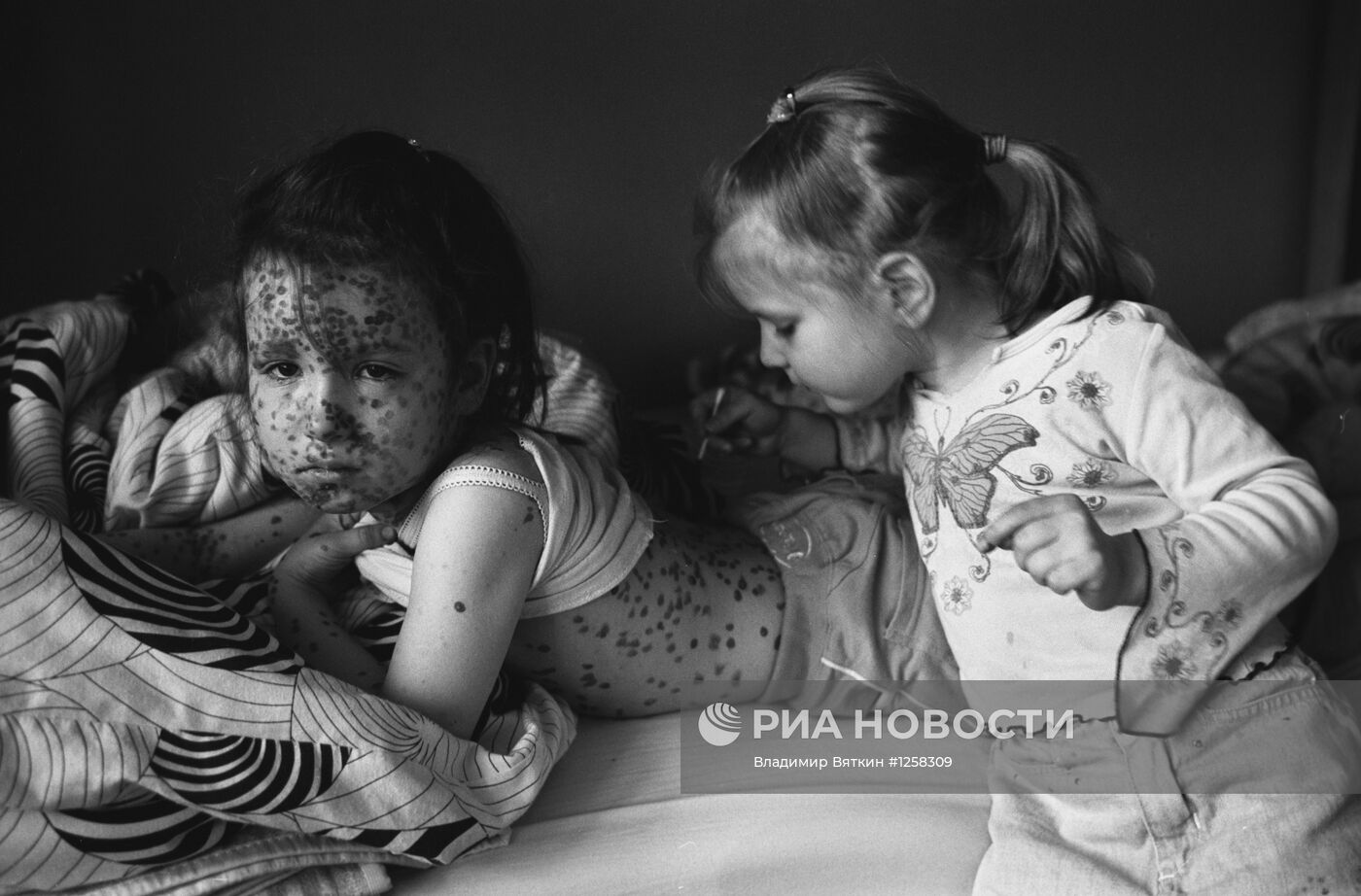 Девочка с ветрянкой