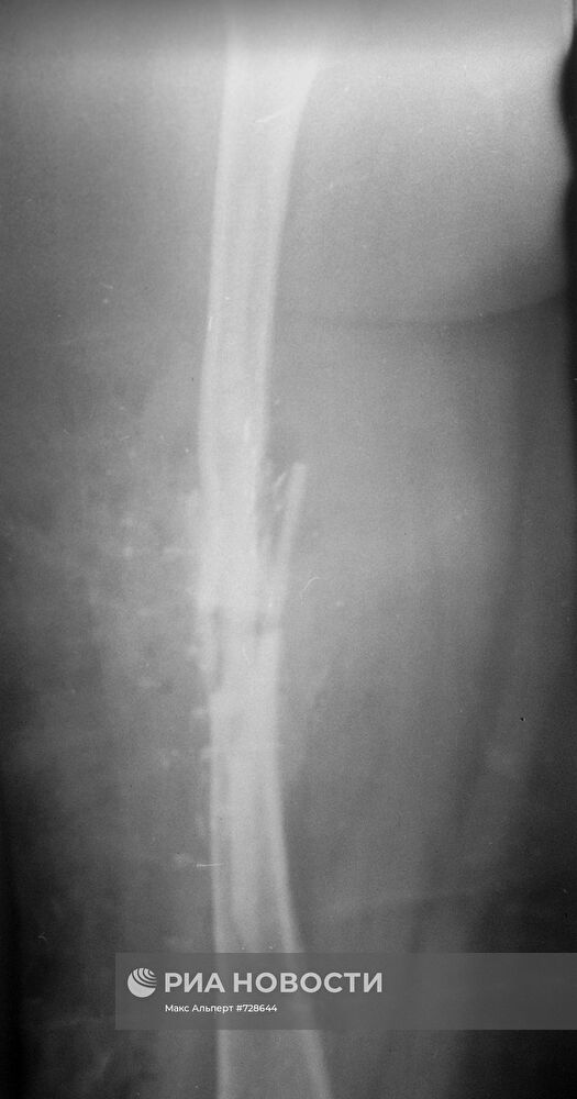 Центральный институт травматологии и ортопедии в Москве