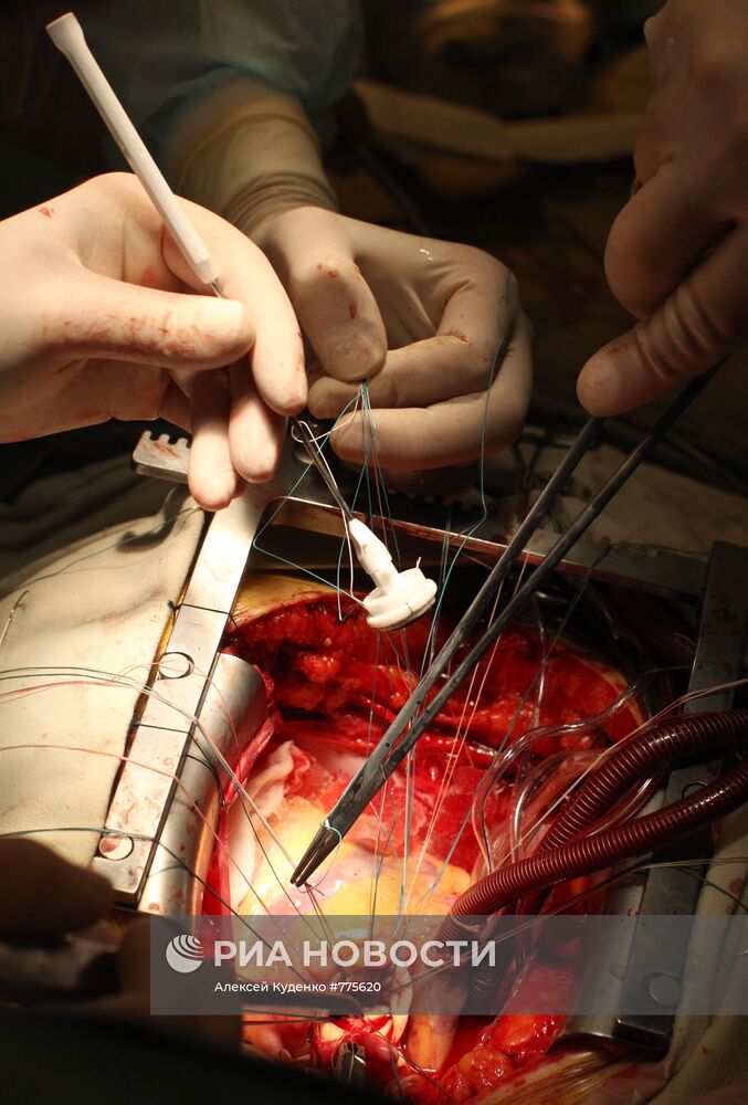 Операция по протезированию клапана сердца