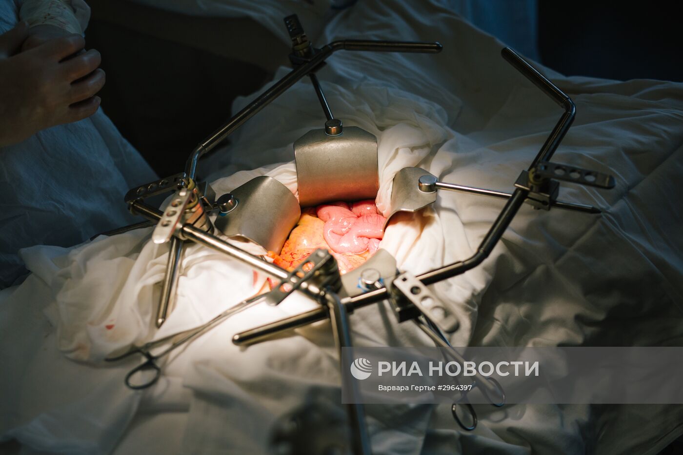 Операция по удалению злокачественной опухоли