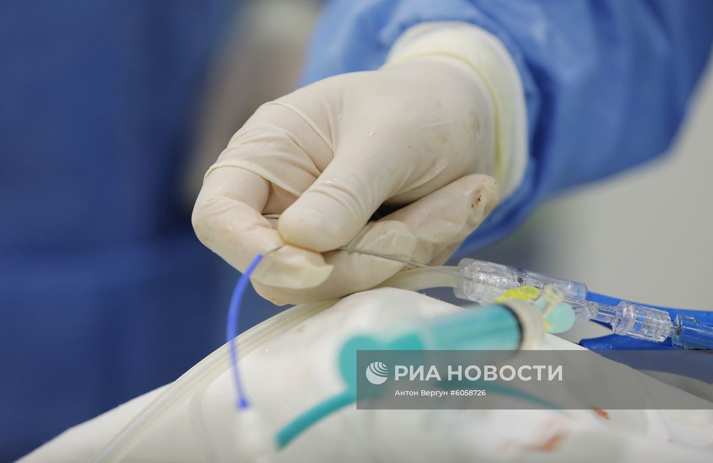 Операция по лечению аритмии с использованием метода криоаблации