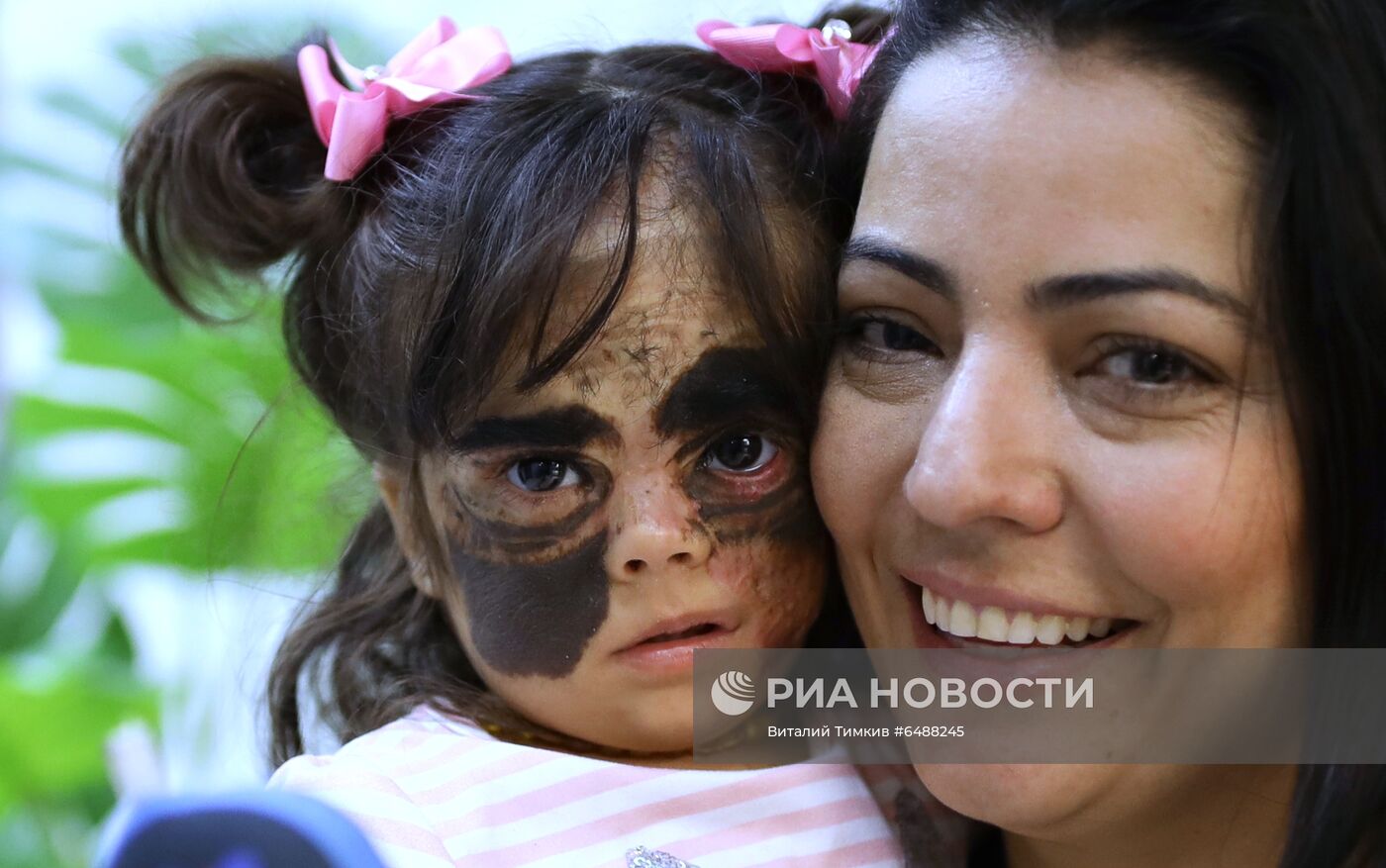 Лечение американской девочки с родимым пятном на лице в Краснодаре 