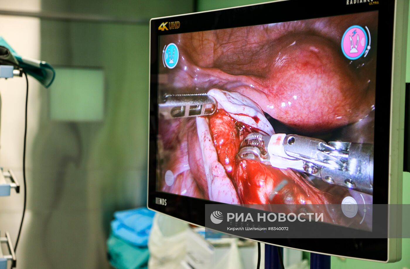 Проведение операции ребенку при помощи роботизированной системы в Иркутске